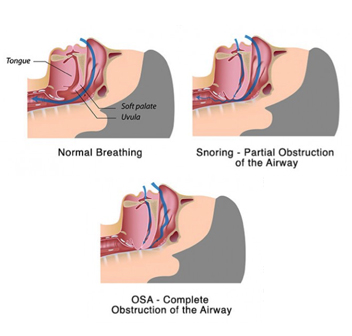 sleep-apnoea-breathing